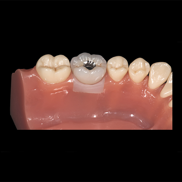 Implant crown